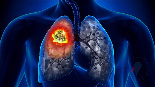 Akciğer kanserinin erken teşhisindeki gelişmeler umut veriyor