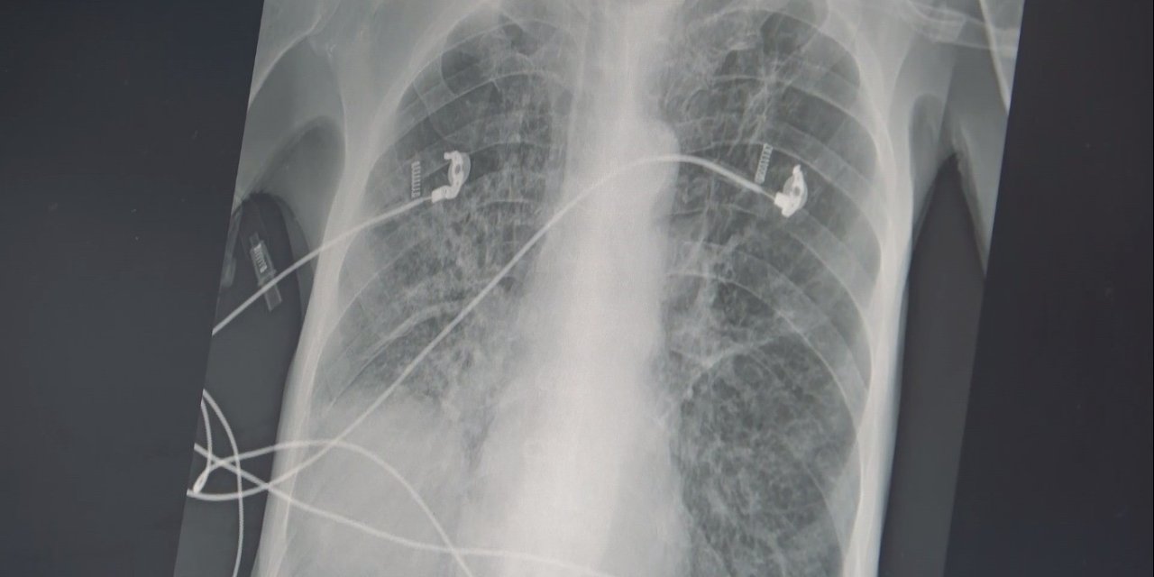 Sigaranın son 2 nefesi: Biri KOAH, diğeri akciğer kanseri