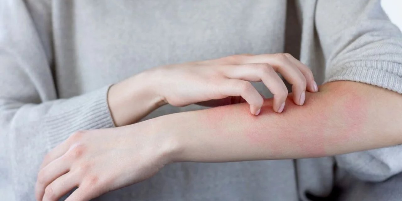 Dermatoloji uzmanları uyarıyor: Gözden kaçırılan 2 belirti cilt kanseri işareti