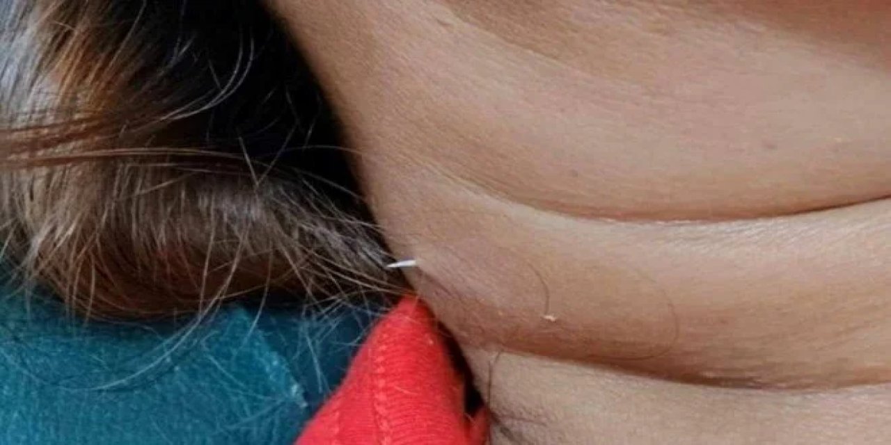 Nasıl bir balıksa: Yuttuğu balık kılçığı boynundan çıktı