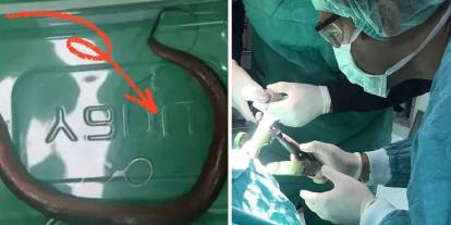 Karın ağrısı şikayetiyle başvurmuştu: Karnından çıkan doktorları hayrete düşürdü