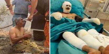 "Yanıyorum" demişti: Orman işçisinin tedavisi sürüyor